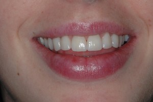 Get a Glowing Smile That Is Sure to Impress
