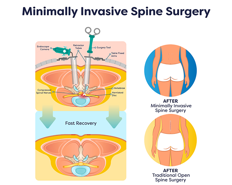 Thoracic spine surgery