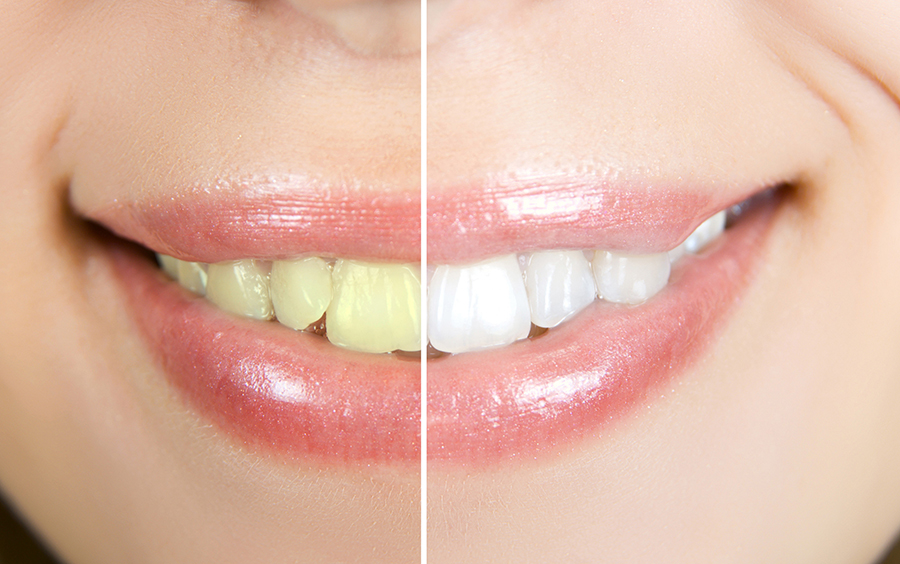 Teeth Whitening Mamaroneck