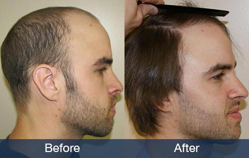 Pennysaver One Of The Best Hair Restoration Clinic In Los Angeles