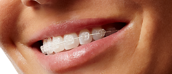 Best Braces in Colorado Springs