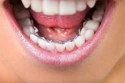 Best Braces in Colorado Springs