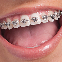 Best Braces in Colorado Springs