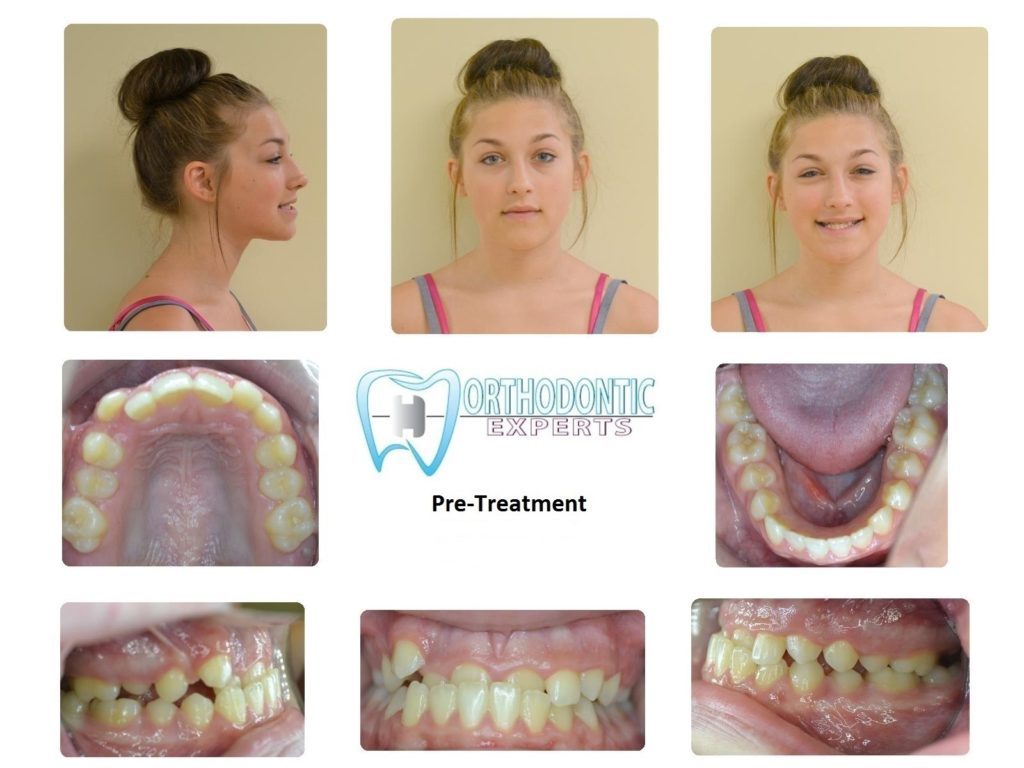 Best Braces in Colorado Springs