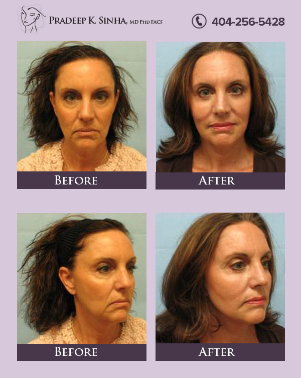 Looking for Best Neck Lift in Atlatna, GA | Dr. Pradeep K. Sinha
