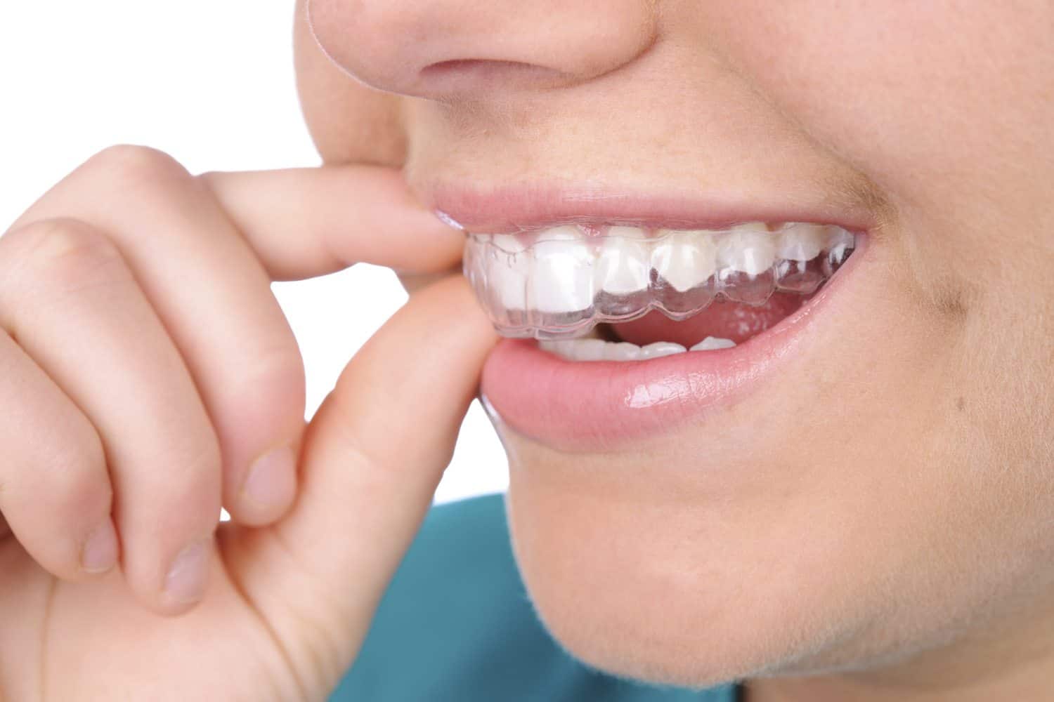 Get the Best Invisible Braces in Colorado Springs!