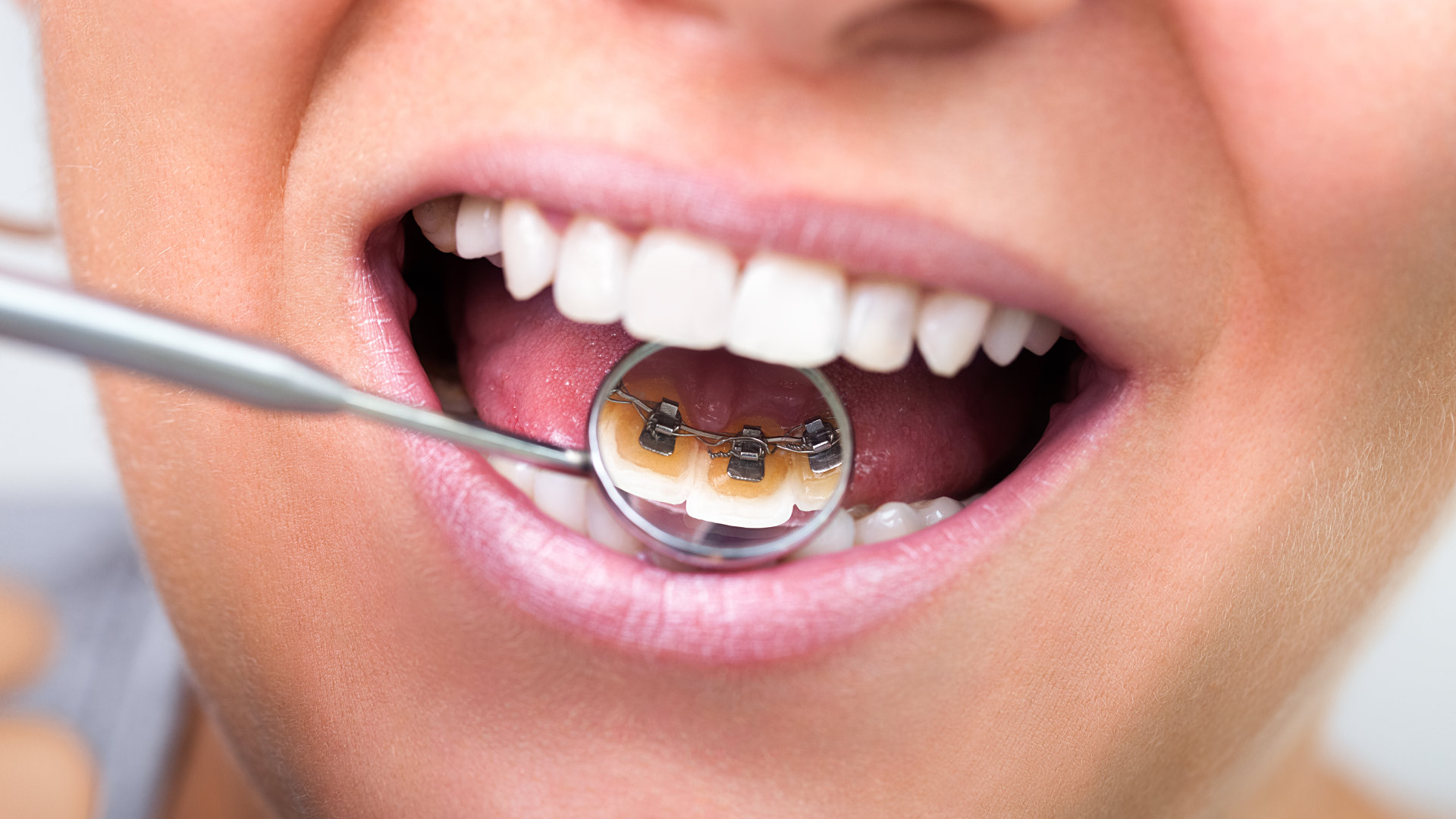 Best Orthodontist in Colorado Springs