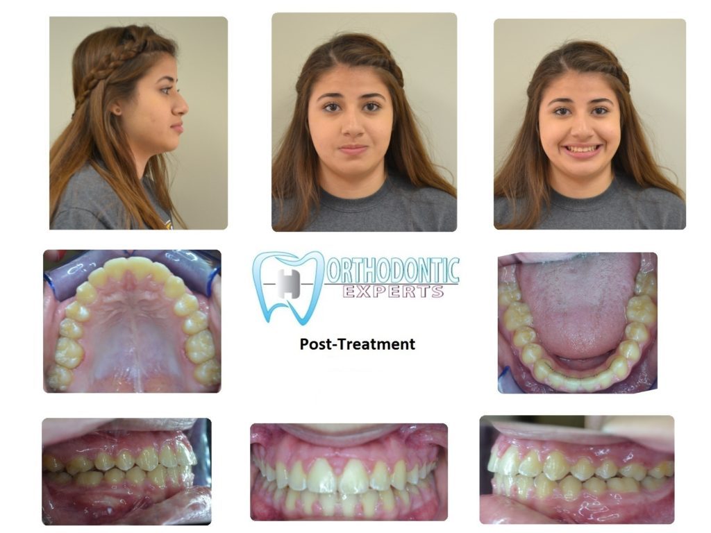 Braces in Littleton Colorado