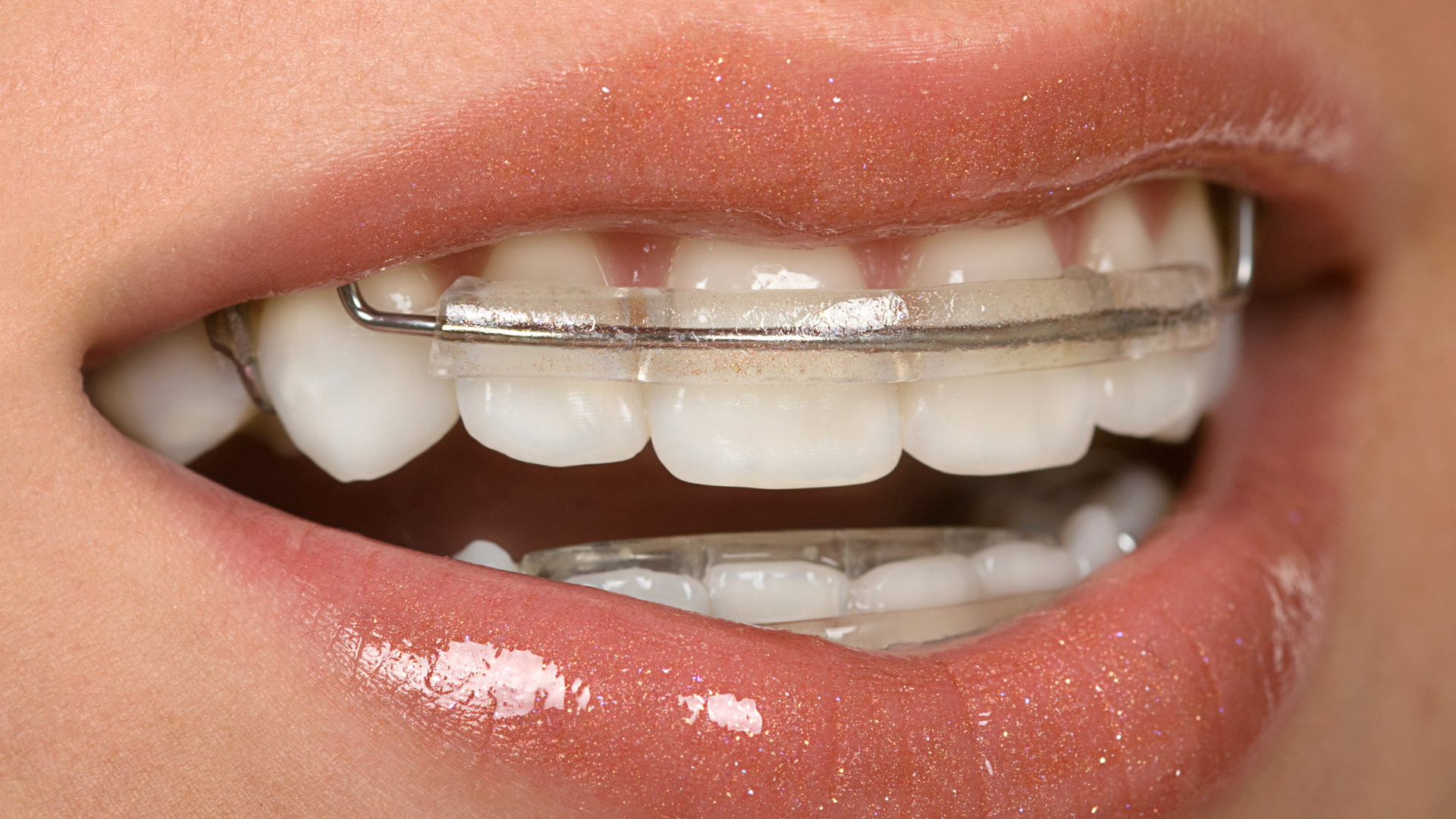 Braces in Littleton Colorado