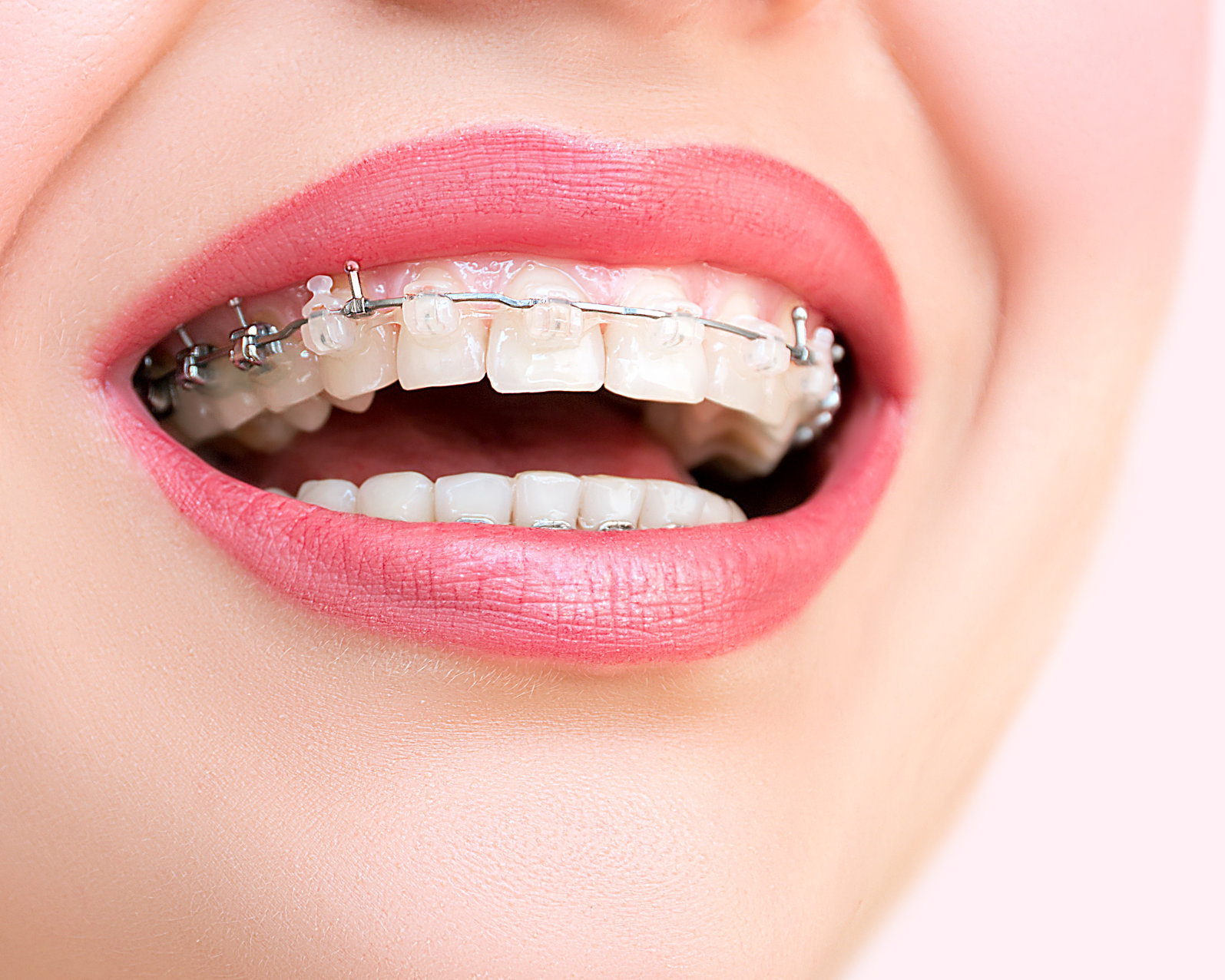 Best Orthodontist in Colorado Springs