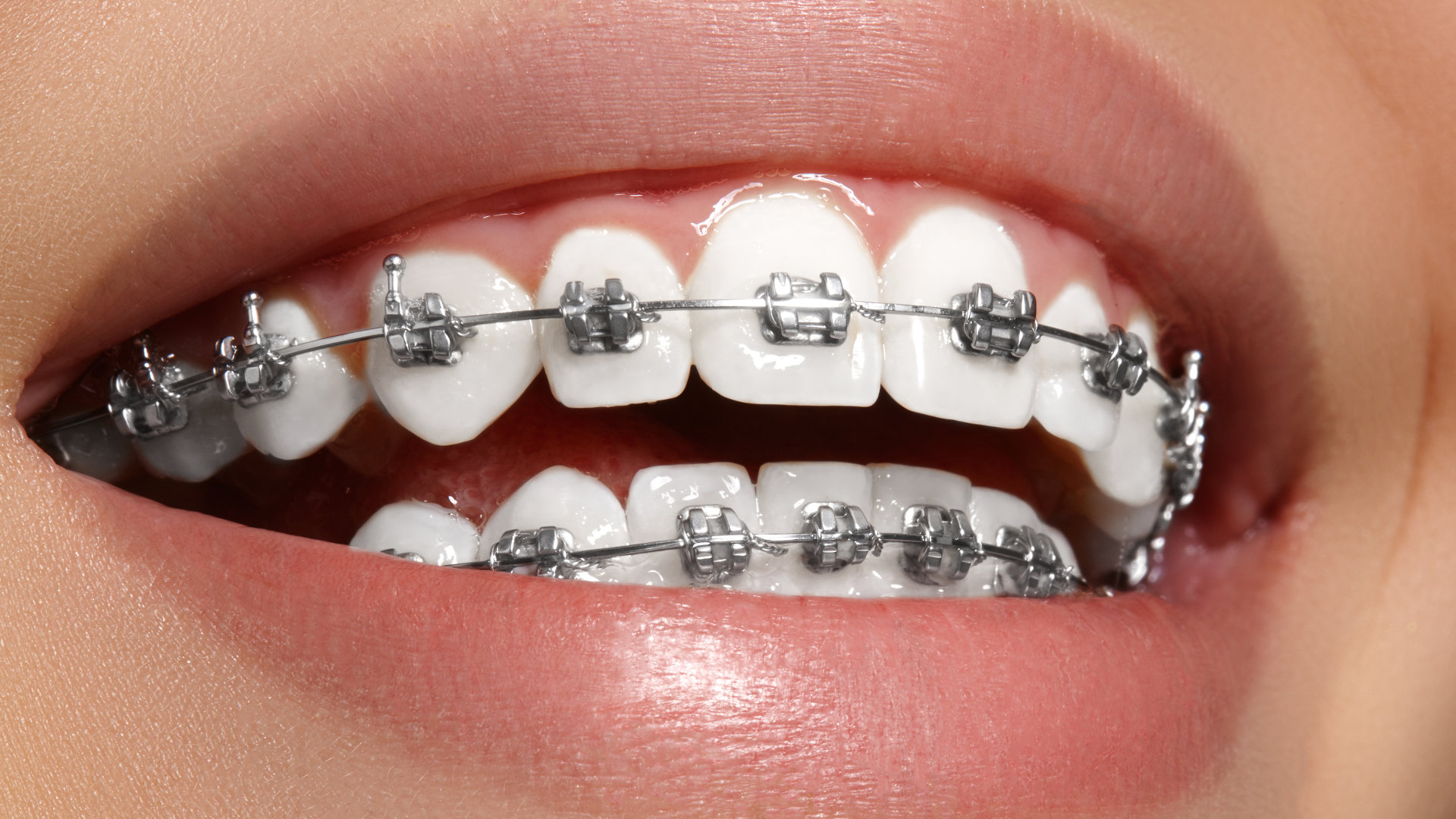 Best Orthodontist in Colorado Springs