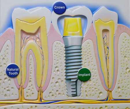 Is your tooth missing? Dental implant is the best option