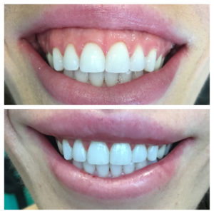 Best lip repositioning specialist in lewisville-tx
