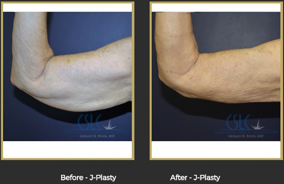 Best Results J-Plasty Stockton- Dr. Gerald Bock
