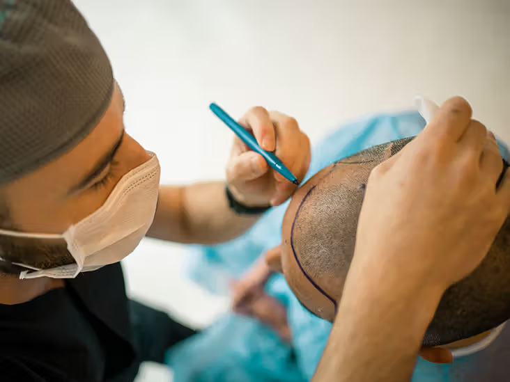 Affordable Male Hair Transplant in Raleigh – Natural Results That Last