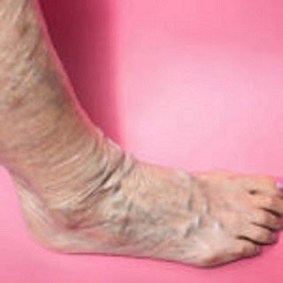 Varicose Vein Treatments Center