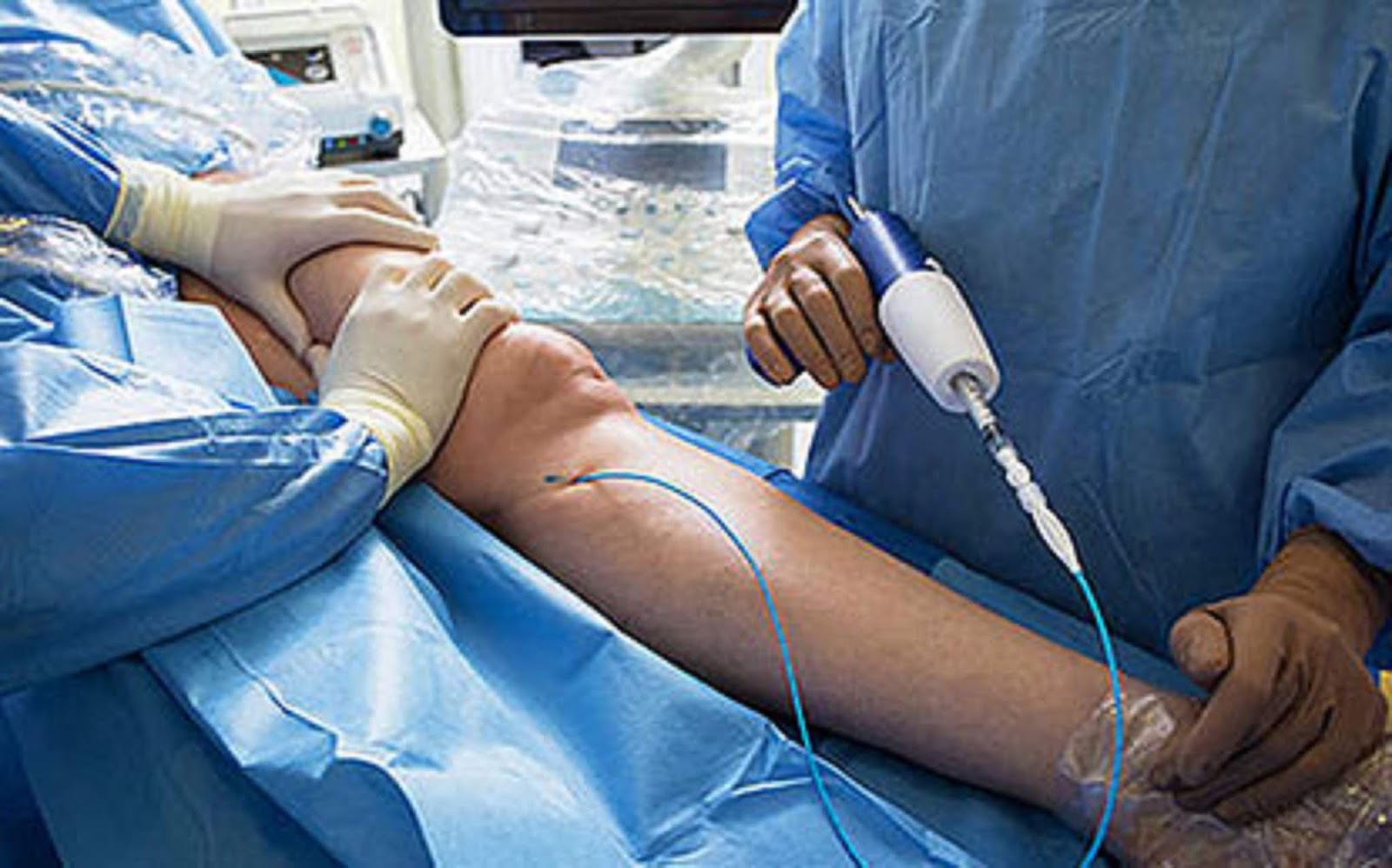 Varicose Vein Treatments Center