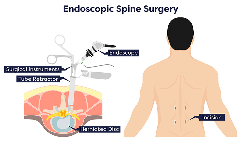 Minimally invasive spine surgery