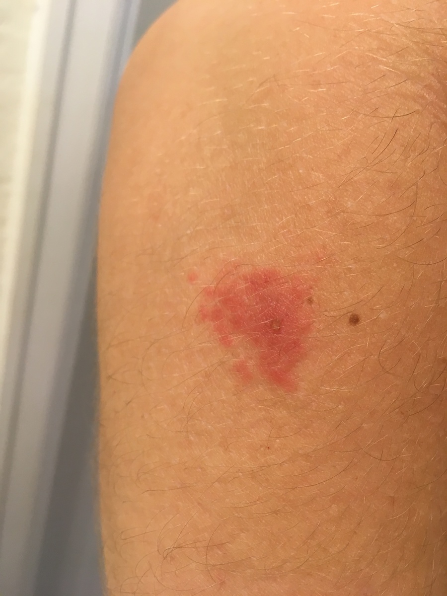 Itchy Red Spot Skin Cancer On Arm