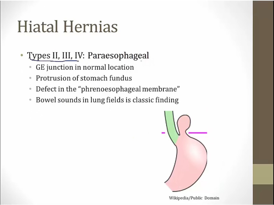 07 Hernia - My Wiki