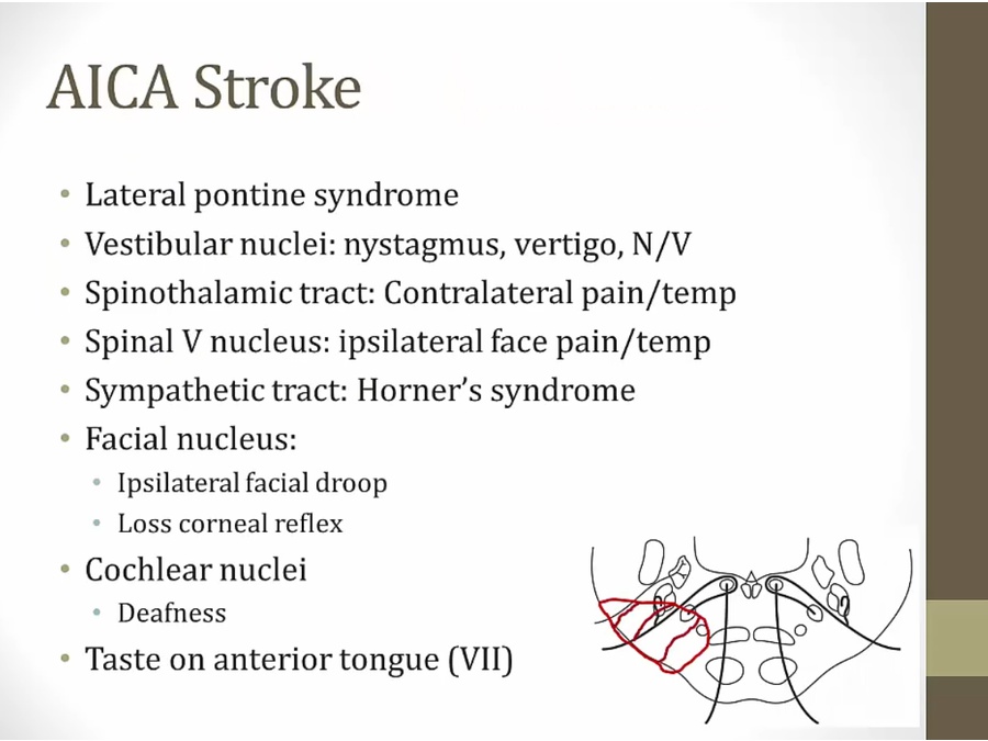 18 Vertebrobasilar Stroke - My Wiki