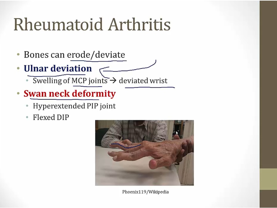 Rheumatoid Arthritis My Wiki