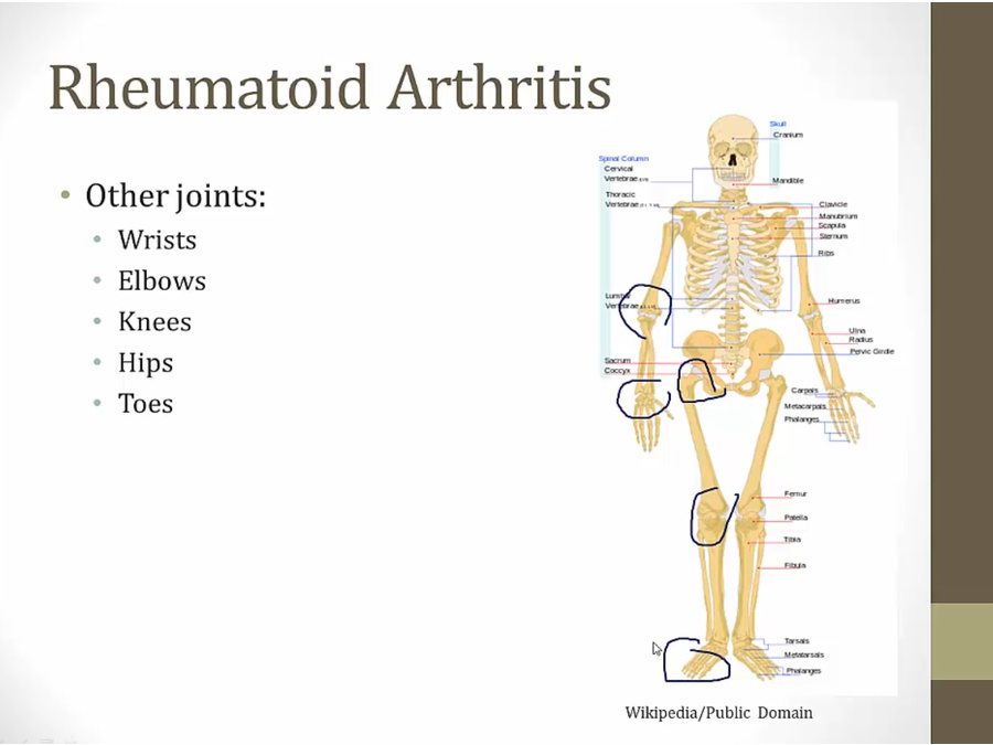 Rheumatoid Arthritis - My Wiki