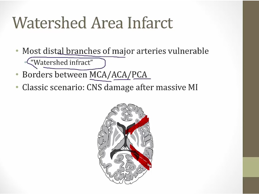17 Cerebral And Lacunar Strokes - My Wiki