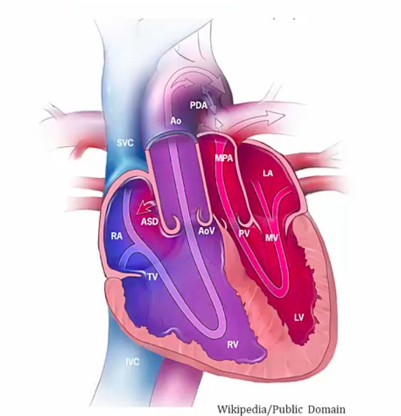 31 Congenital Heart Disease - My Wiki