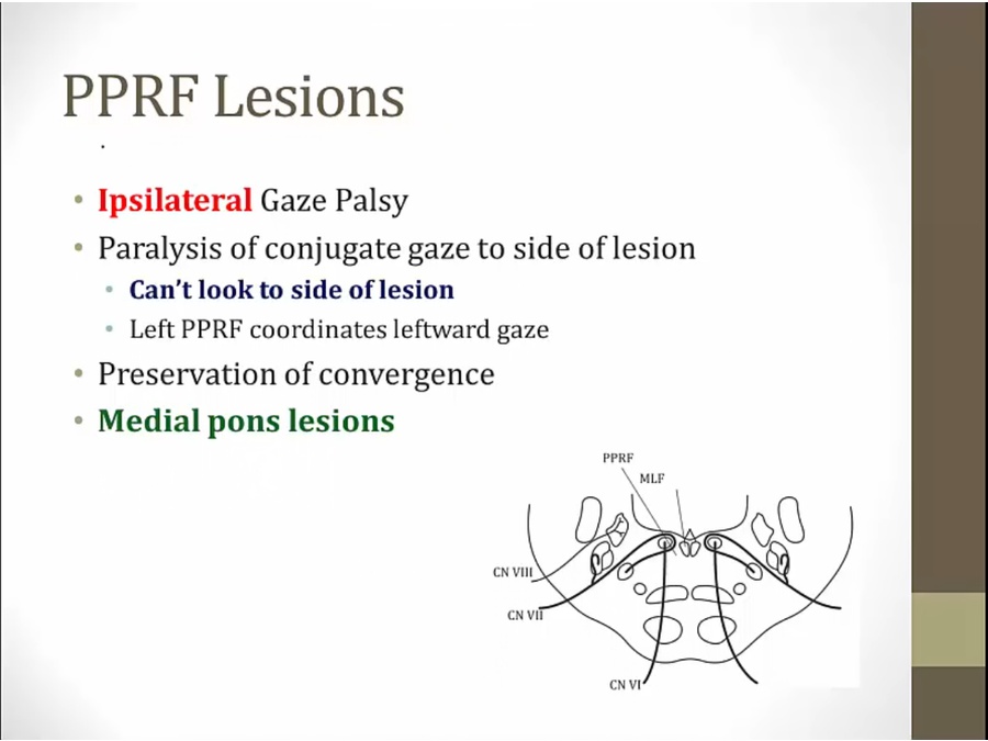 30 Gaze Palsies - My Wiki