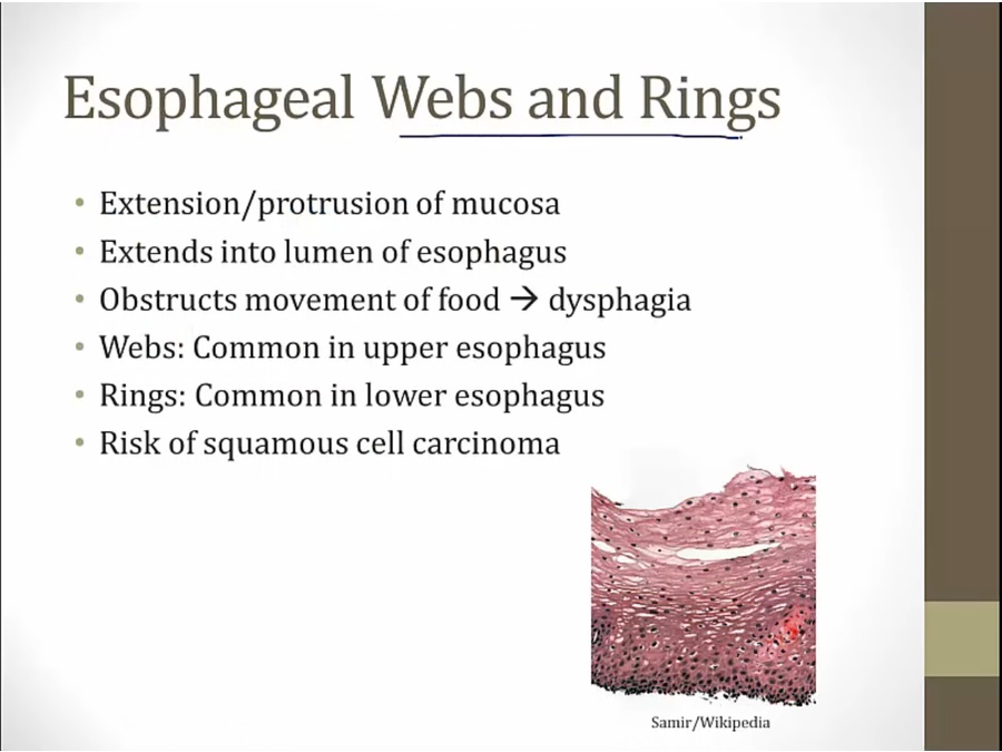 13 Esophageal Disorders My Wiki 13-esophageal-disorders-my-wiki