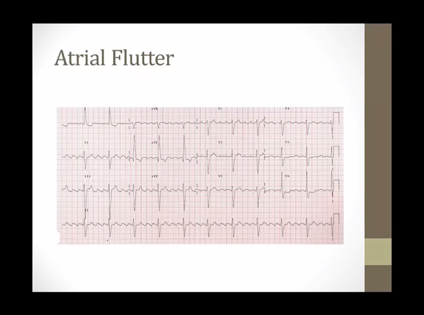 15 EKG Others - My Wiki