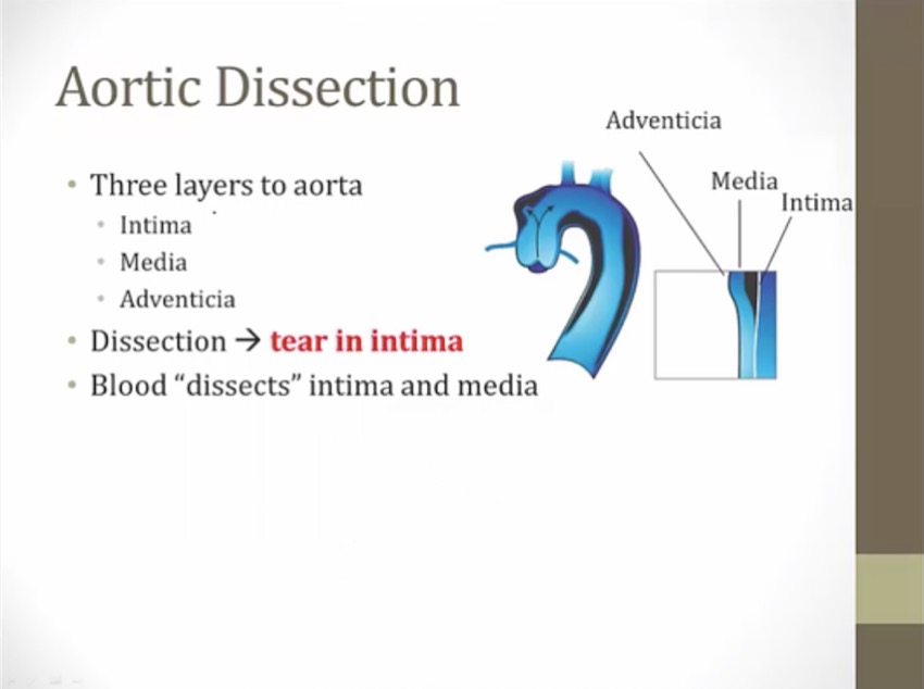 37 Aortic Dissection - My Wiki