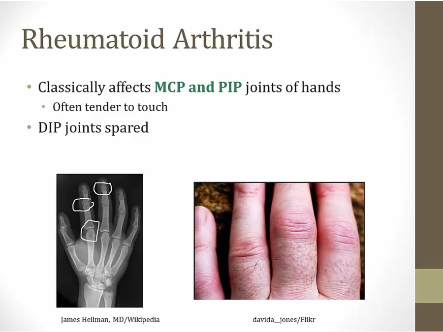 Rheumatoid Arthritis My Wiki