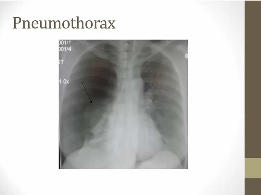 14 Pleural Disease - My Wiki