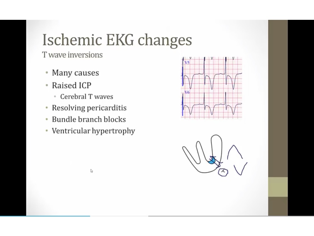 10 Cardiac Ischemia - My Wiki