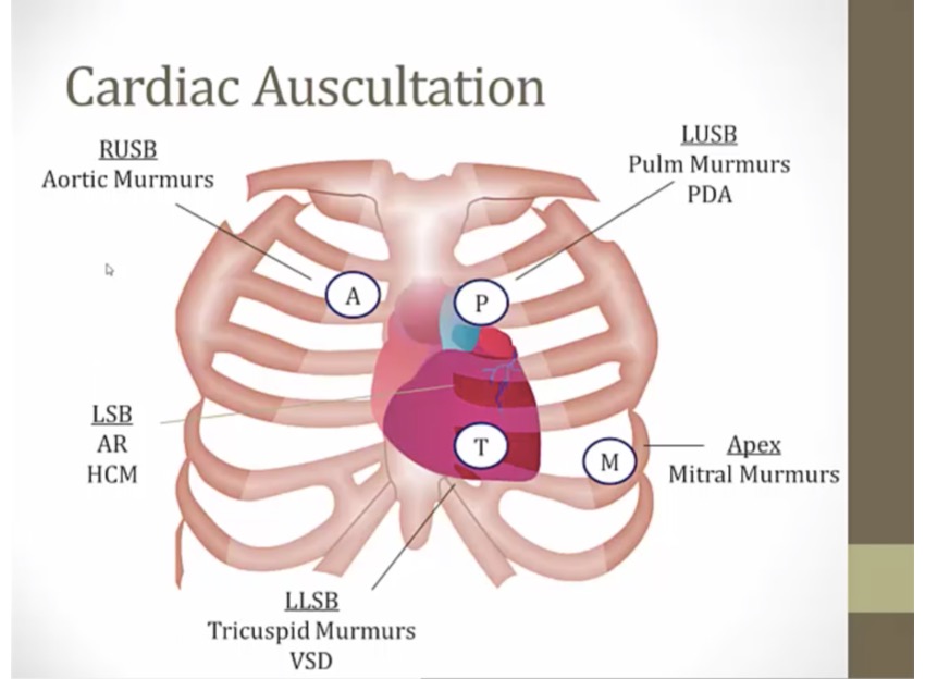 22 Heart Murmurs - My Wiki