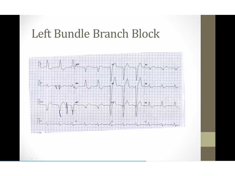 15 High Yield EKG - My Wiki