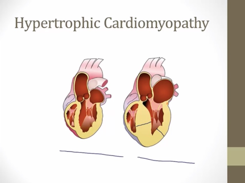 39 Hypertrophic Cardiomyopathy - My Wiki