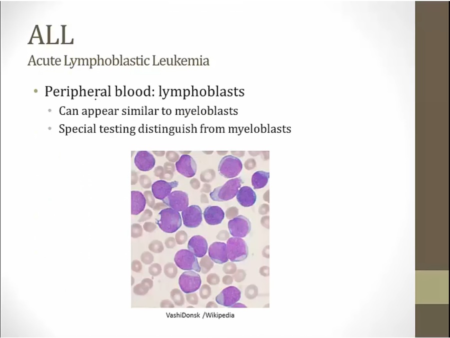 16 Acute Leukemia - My Wiki