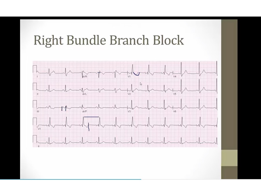 15 High Yield EKG - My Wiki