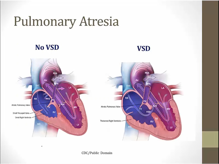 31 Congenital Heart Disease - My Wiki