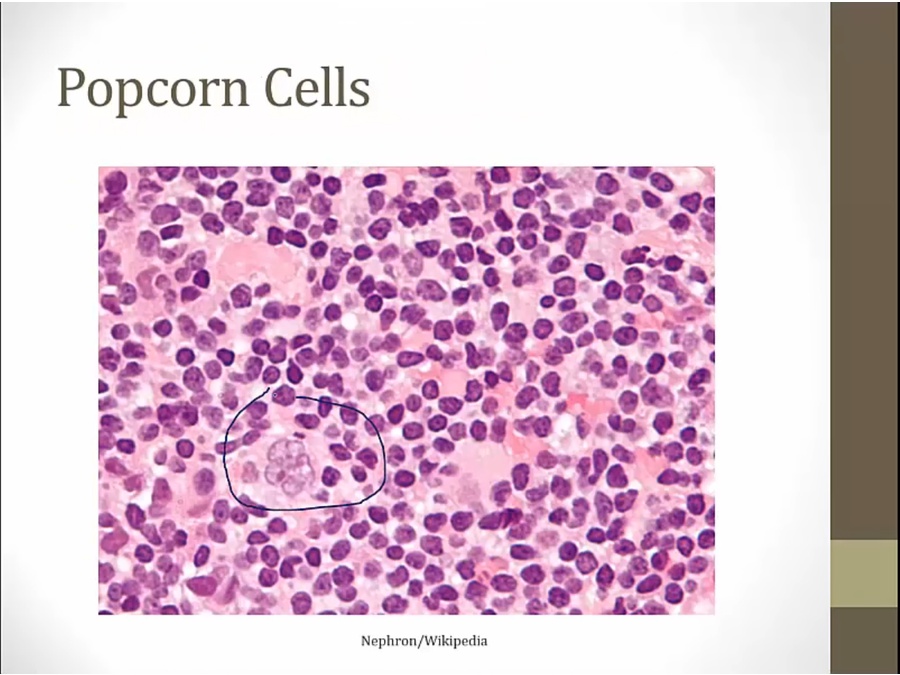 18 Hodgkin Lymphoma - My Wiki