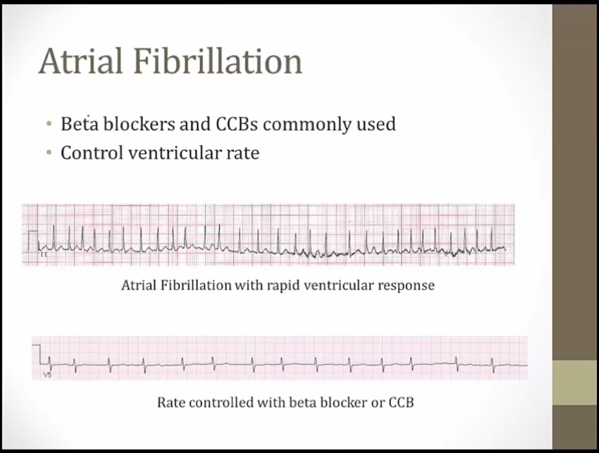 21 Antiarrhythmics - My Wiki