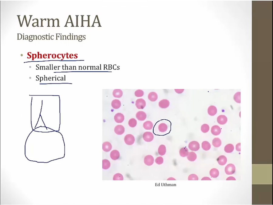 09 Extrinsic Hemolysis - My Wiki