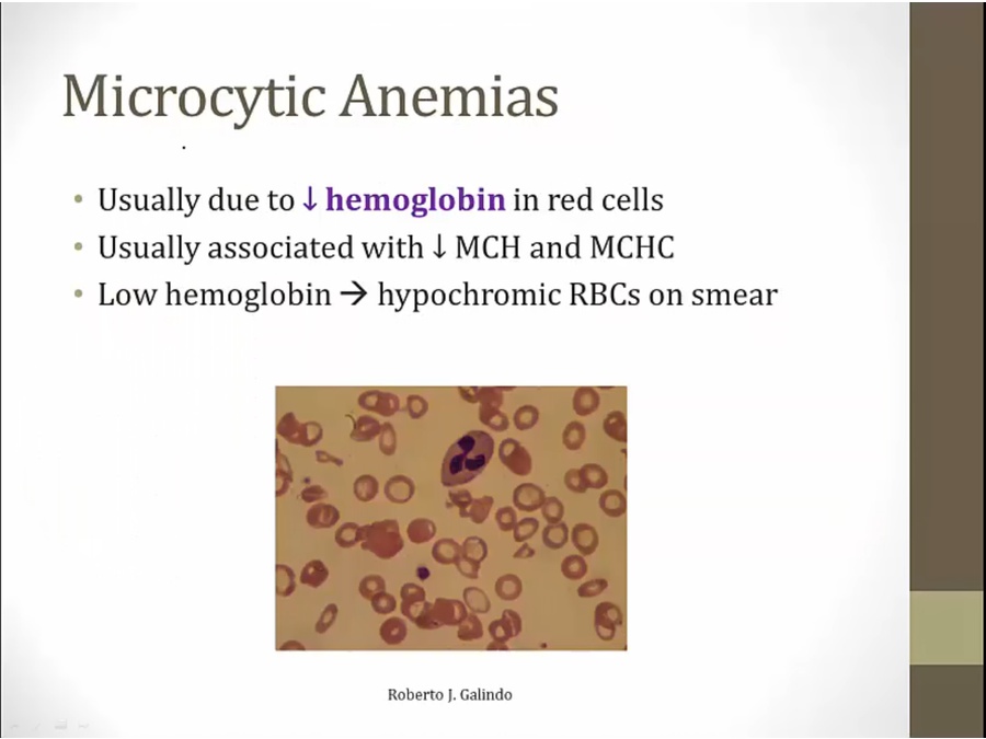 11 Microcytic Anemia My Wiki 6772